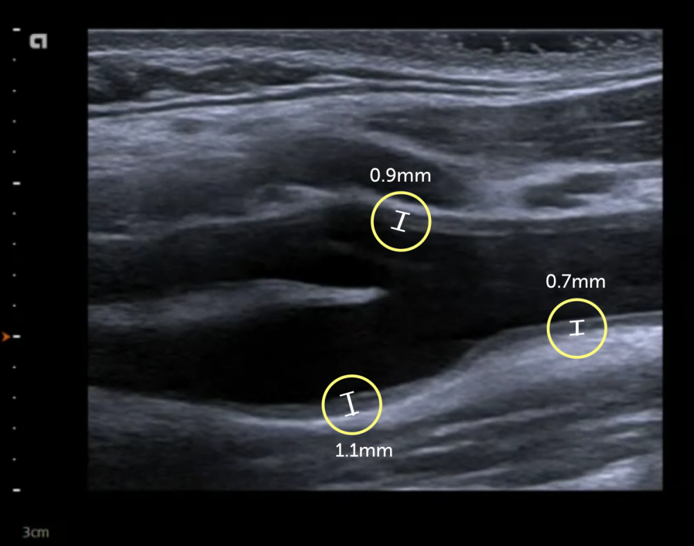 9 Assessment Of Intima Media Thickness Imt 123sonography